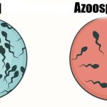 Azoospermia